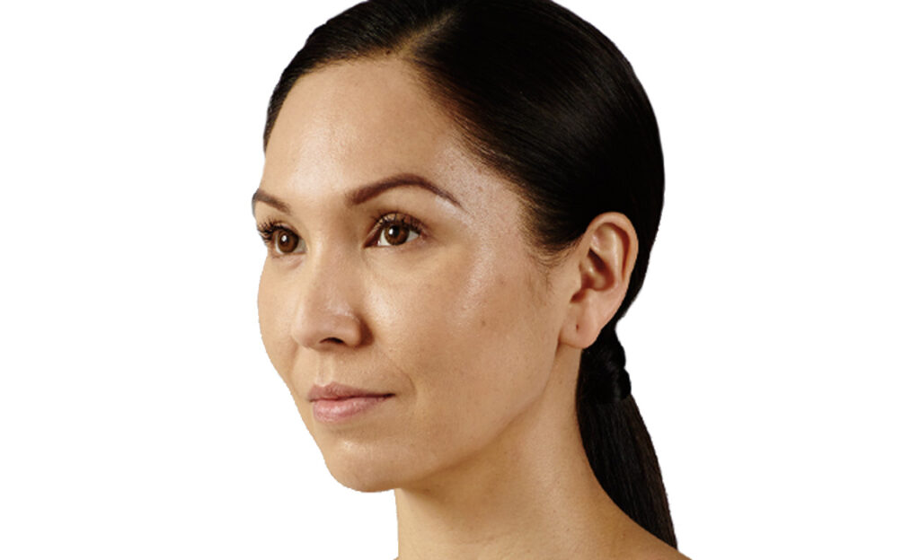 Juvederm Voluma Khouri Dermatology